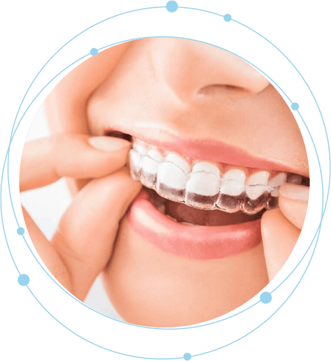 A person with braces on their teeth is holding something in his mouth.